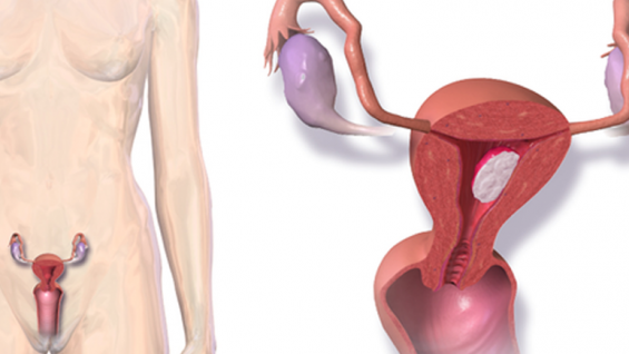 Рак на матката – причини, симптоми и лечение